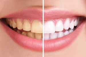 Blanchiment dentaire à Javea - Votre dentiste specialiste à Javea