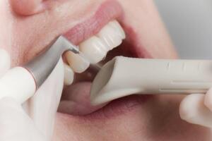 Détartrage et nettoyage dentaire à Javea : Dentiste Javea