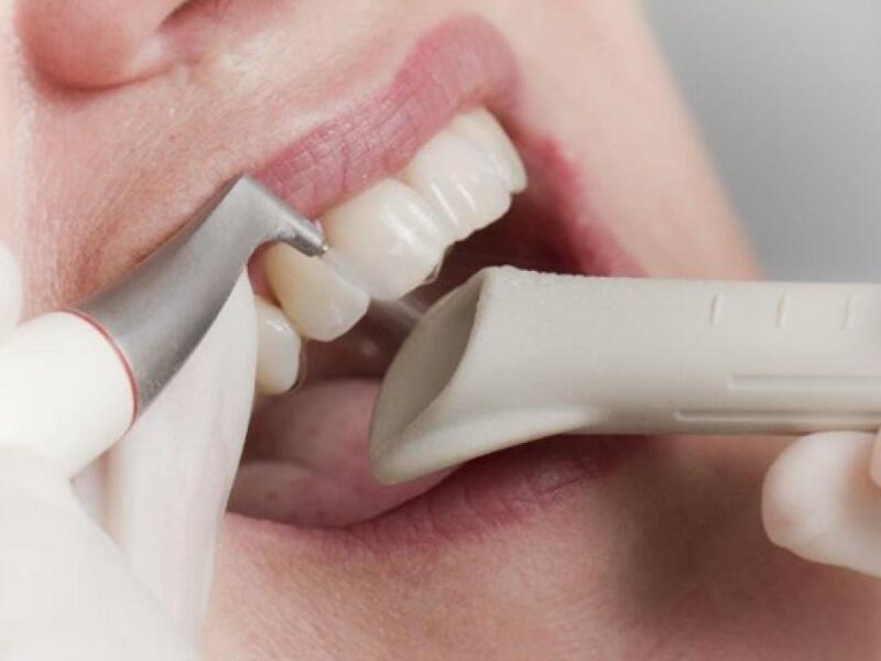 Détartrage et nettoyage dentaire à Javea : Dentiste Javea